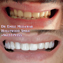 Composite Veneers Lebanon