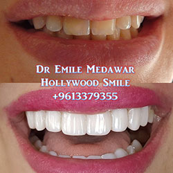 Composite Veneers Lebanon